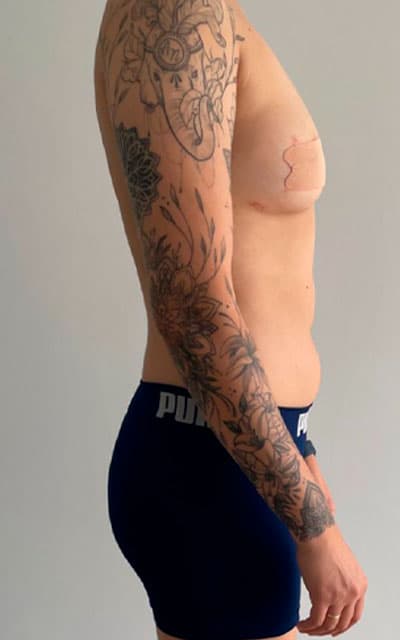 Antes do acompanhamento de João Gabriel - 3 anos de Protocolo T. Faz uso de T; sem mastectomia